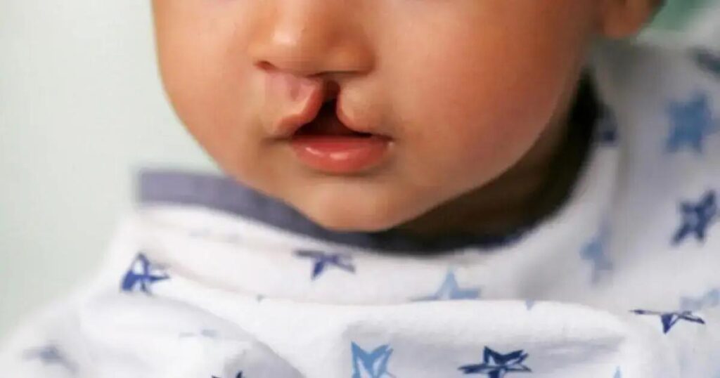 Aumento de 40% em cirurgias de lábio leporino em Salvador nos últimos anos