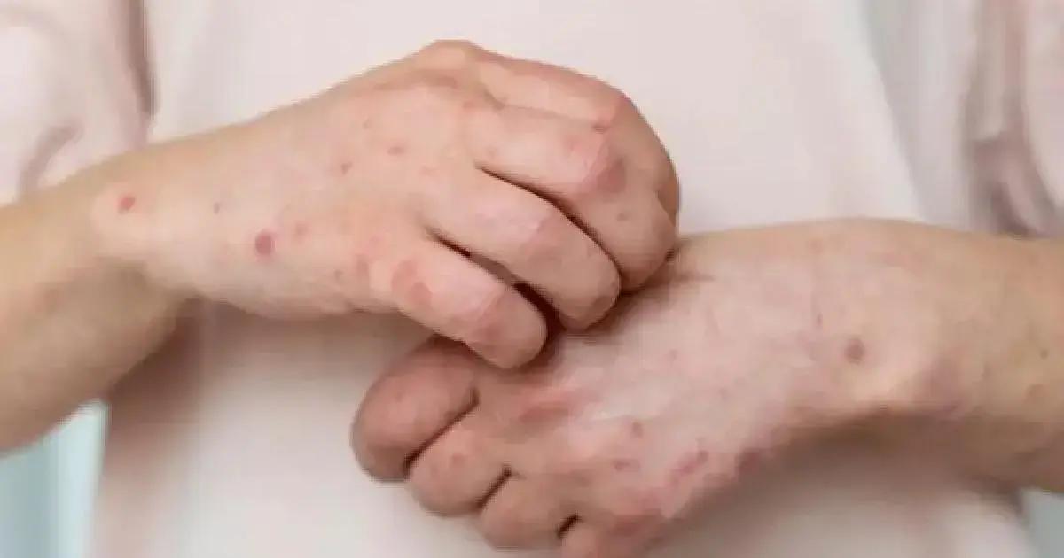 OMS emite alerta sobre surto de antraz na República Democrática do Congo