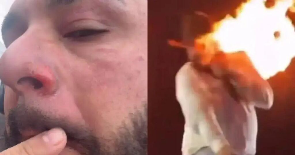 Sertanejo Léo mostra ferimentos após acidente com efeito especial em show