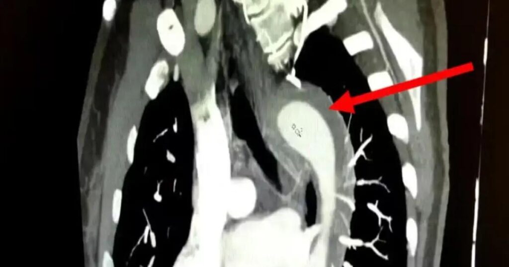 Mulher sobrevive a rompimento da aorta durante relação sexual