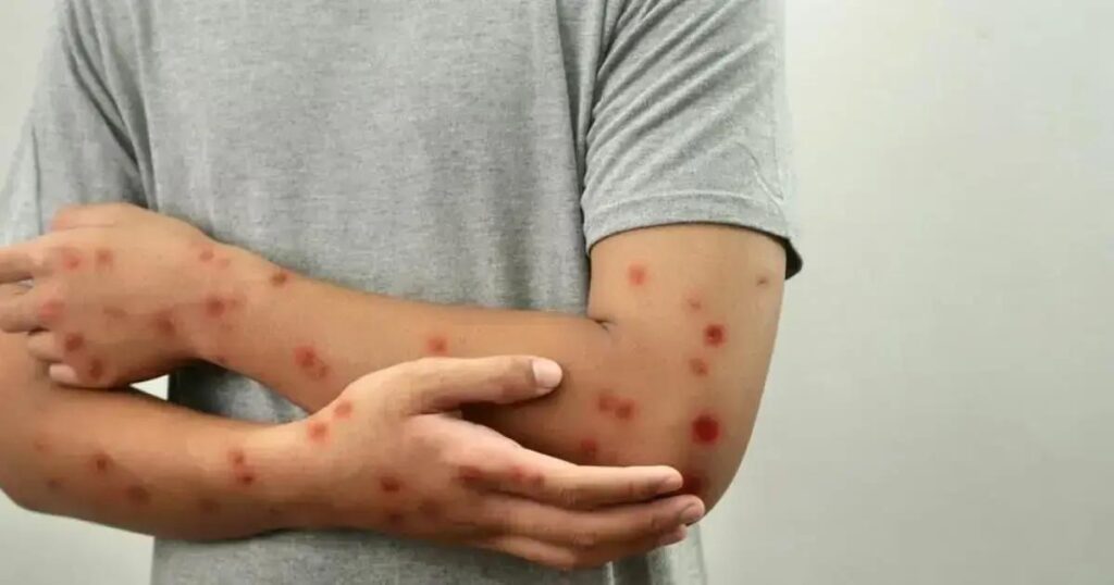 Anvisa orienta sobre mpox e sarampo em portos e aeroportos