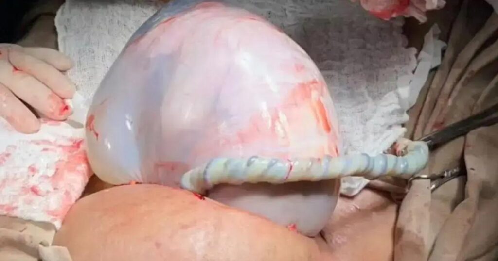 Bebê nasce envolto em bolsa durante parto raro em Irecê; conheça o caso