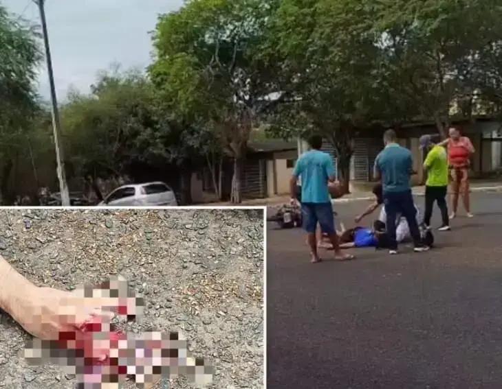 Jovem perde dedo em grave acidente de moto em Itapetinga