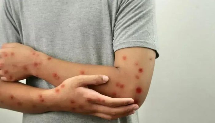 Anvisa orienta sobre mpox e sarampo em portos e aeroportos