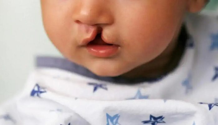 Aumento de 40% em cirurgias de lábio leporino em Salvador nos últimos anos