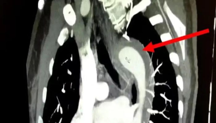 Mulher sobrevive a rompimento da aorta durante relação sexual