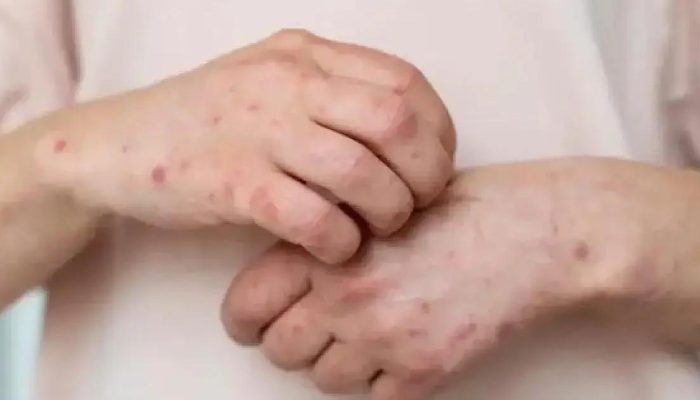 OMS emite alerta sobre surto de antraz na República Democrática do Congo