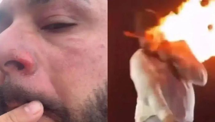 Sertanejo Léo mostra ferimentos após acidente com efeito especial em show
